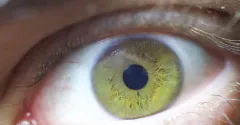 Keratokonus