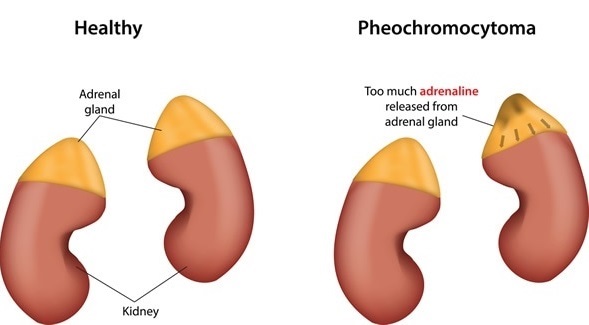 Adrenal (Böbrek üstü bezi) Tümörler
