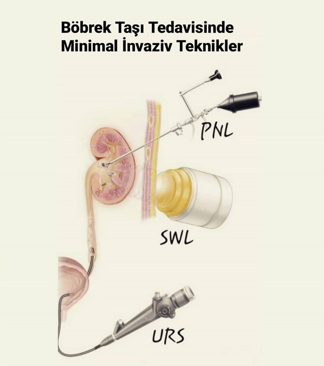 Böbrek Taş Hastalıkları