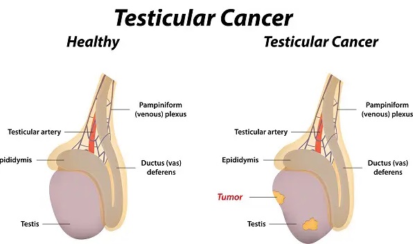 Testis Kanseri