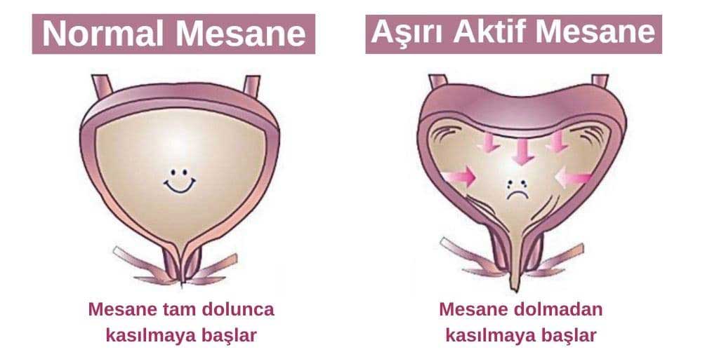 Aşırı Aktif Mesane