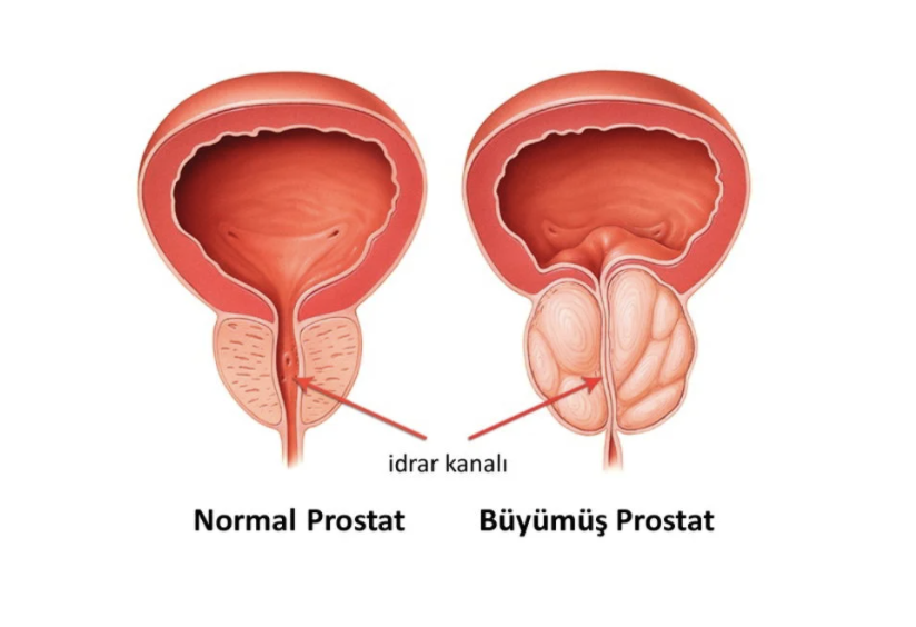 İyi Huylu Prostat Büyümesinde (BPH) İlaç Tedavisi