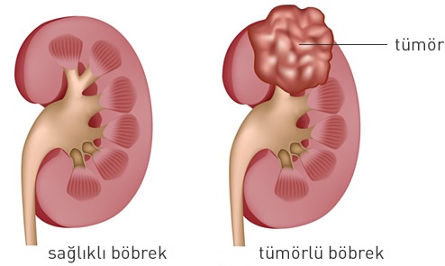 Böbrek Kanseri