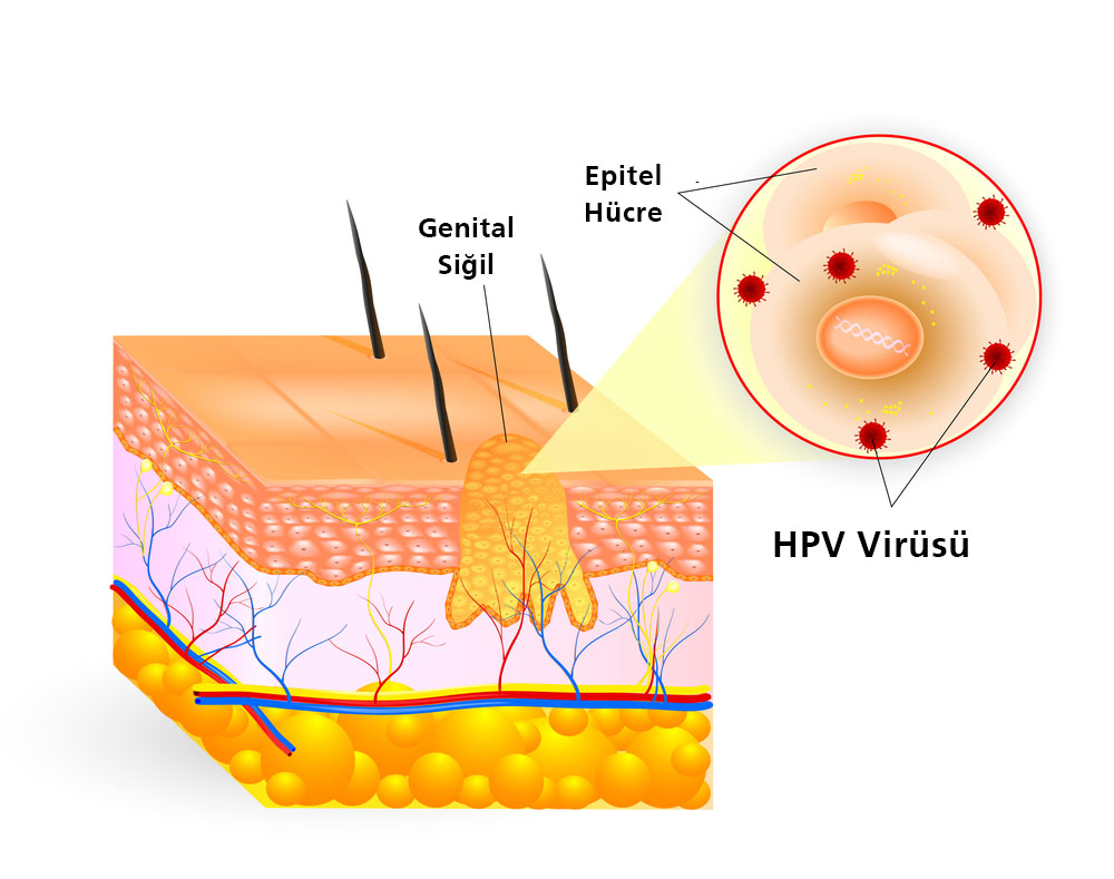 Gental Siğil (Kondilom) ve HPV