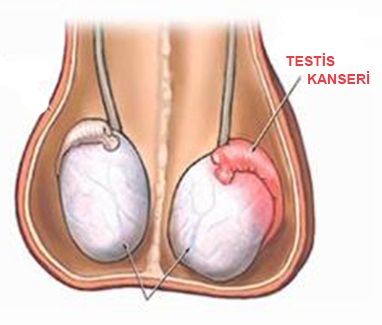 Testis Kanseri