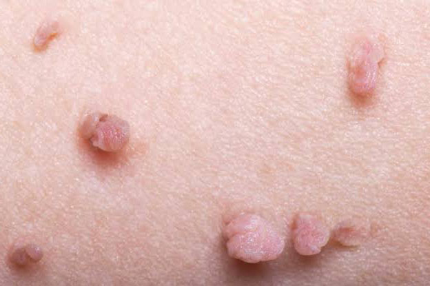 Gental Siğil (Kondilom) ve HPV