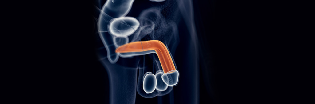 Penis Eğriliği Ameliyatı