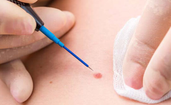 Genital Siğil (Kondilom) ve HPV