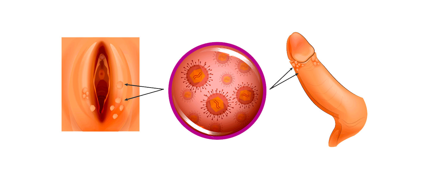 Gental Siğil (Kondilom) ve HPV
