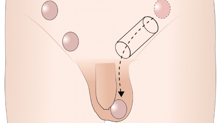İnmemiş Testis